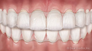 Clear aligners.