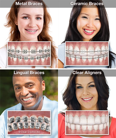 Orthodontic Appliance Options.